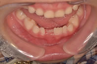 （症例4）乳歯が一本抜けてしまった