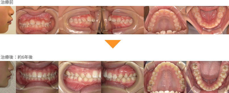（症例10）出っ歯で上の歯が大きく前に出て下の歯が見えない