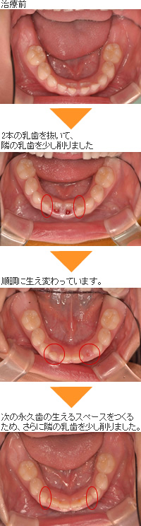 乳歯から永久歯へ生え変わりトラブルの治療