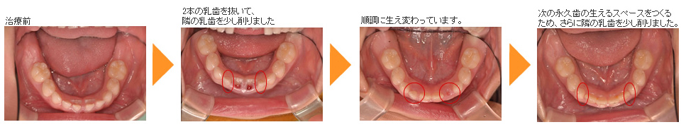 乳歯から永久歯へ生え変わりトラブルの治療