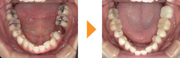 症例3：重度のむし歯で歯を大きく削るため、セラミッククラウンの被せモノに（30代女性）