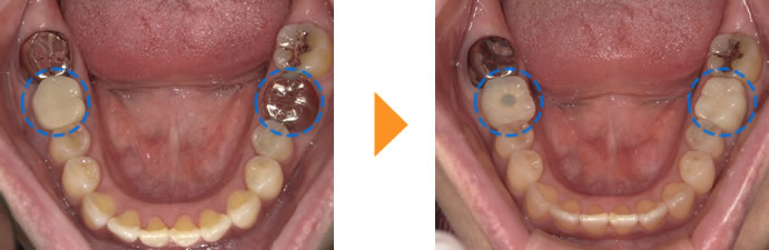 症例7：歯が欠けた/歯ぐきが腫れている（歯が割れている）（40代女性）