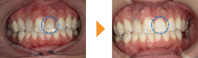 症例8：前歯の色が気になる（30代女性）