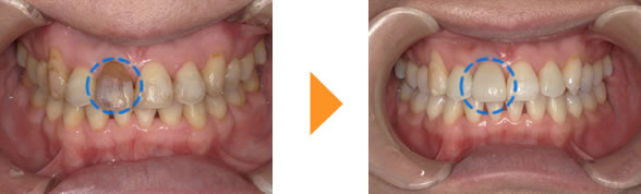 症例11（右上の前歯）の色が気になる（40代女性）