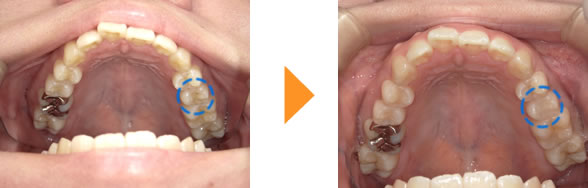 症例12：左上の銀歯がむし歯になった（50代女性）