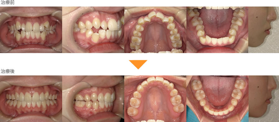 上の八重歯、下の歯並びが気になる。