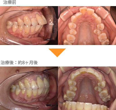 （出っ歯の症例14）上の前歯が2本張り出ている。