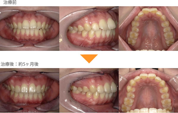（出っ歯の症例15）上の前歯の歯並びが気になる（出っ歯）