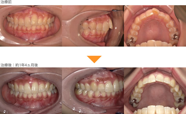（出っ歯の症例25）上の前歯の歯並びが気になる。
