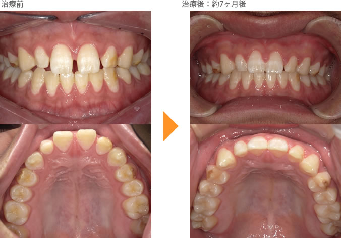 （すきっ歯の症例10）上の前歯のすき間があいている。