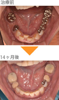 （八重歯の症例5）下の前歯の歯並びが気になる