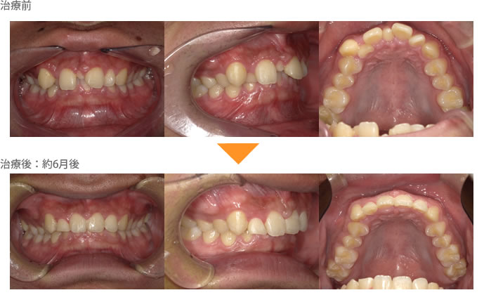 （八重歯の症例24）上の前歯がデコボコしている