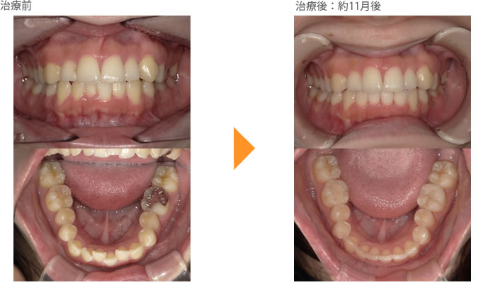 （八重歯の症例25）上の前歯がデコボコしている