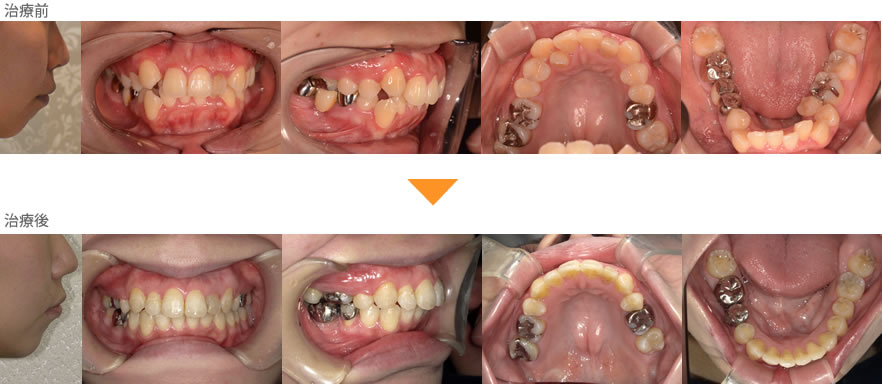 （症例40）前歯の歯並びが悪い